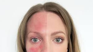 Get Tips On How To Overcome Skin Issues Here